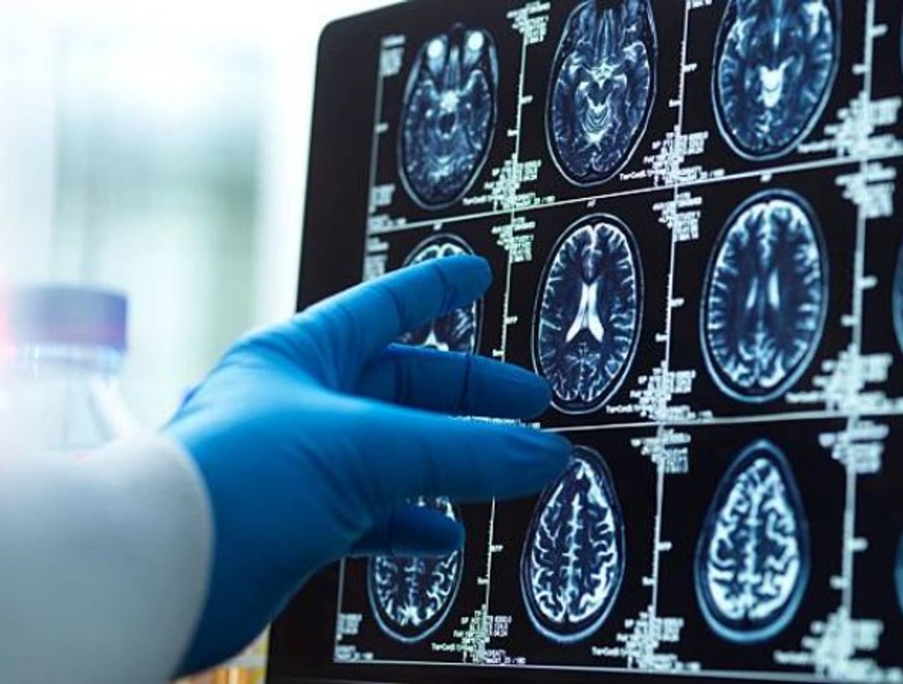 Migraña: alimentos que podrían ayudar a prevenir sus síntomas